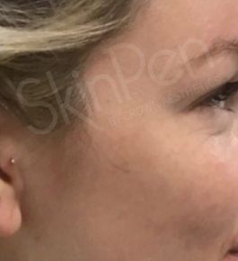 Picture for category SkinPen Microneedling